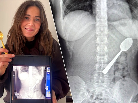 En plots belandt lepel van 17 centimeter in maag van Reymy (28) uit Rumst:  “Het was slikken of... stikken” | Rumst | HLN.be