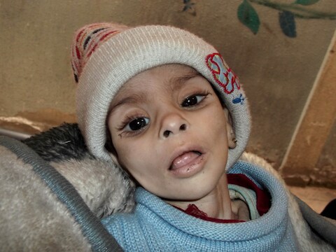 Een zwaar ondervoed meisje in het vluchtelingenkamp Yarmouk, dat kort daarna zou overlijden.
