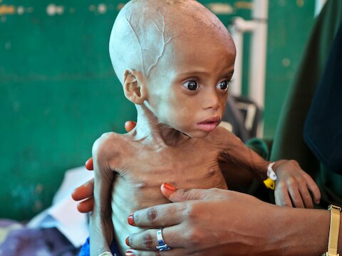 De negen maanden oude Sacdiyo Mohamed is zwaar ondervoed. Hij wordt behandeld in het Banadir-ziekenhuis in Mogadishu, Somalië, nadat zijn moeder de droogte in het zuiden van het land ontvluchtte.