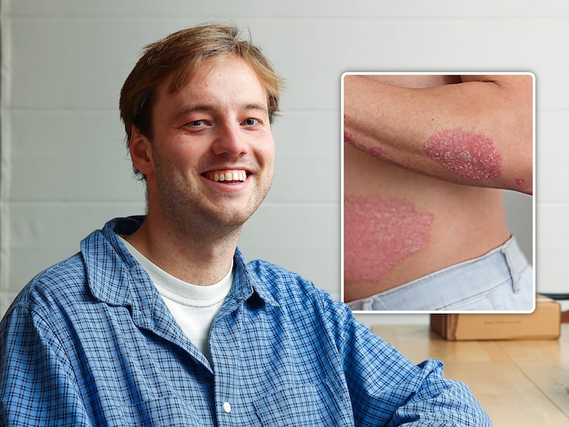 Vandaag, 29 oktober, is Wereldpsoriasisdag. Tim (25) getuigt over de aandoening. 
