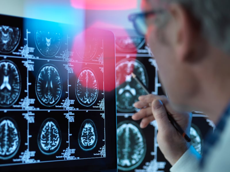 Eindelijk hoop? “Alzheimeronderzoek in stroomversnelling na jaren van tegenslag”