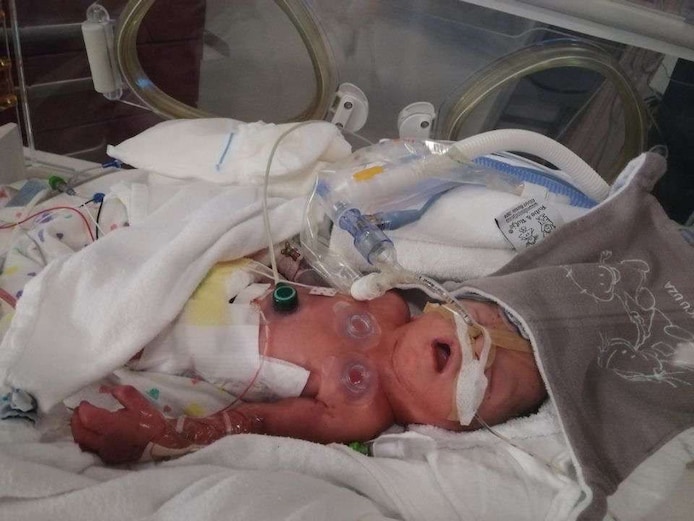 Zelfs na 50 operaties kan een simpele verkoudheid voor Adam (5) dodelijk zijn: “Er moet toch ergens één dokter zijn die hem echt kan helpen?” | Exclusief voor abonnees | hln.be