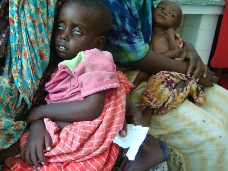 Ondervoede kinderen in een ziekenhuis in Mogadishu.