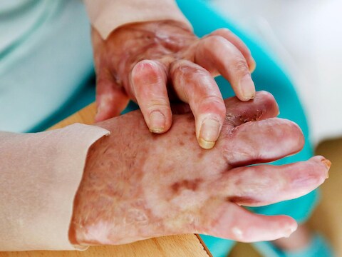 De Duitse dokter Kizilhan helpt Yasmin nu met haar brandwonden.