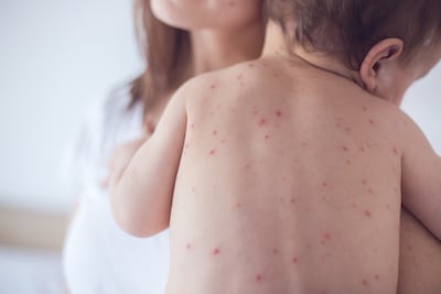 Verenigde Staten beleven zwaarste mazelenjaar sinds 1991: al 2.318 besmettingen, vooral kinderen getroffen