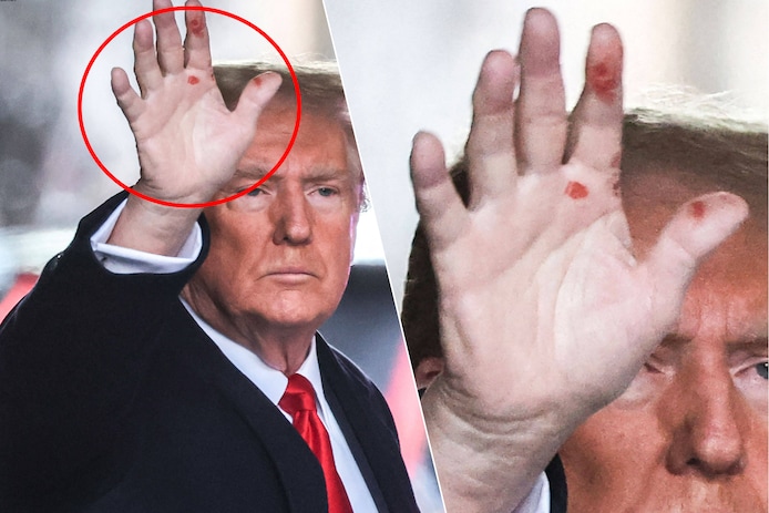 Mysterieuze rode vlekken op de hand van Donald Trump doen vragen rijzen ...