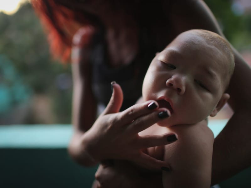 Een vijf maanden oude baby met microcefalie in Recife. De aangeboren afwijking wordt in verband gebracht met het zikavirus.