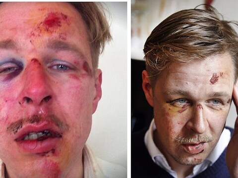 Wilfred de Bruijn werd zwaar mishandeld op straat.