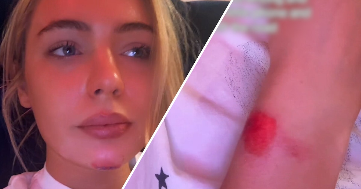 Fietsende Jutta Leerdam gewond geraakt: “Van de baan gereden door automobilist die op zijn telefoon 