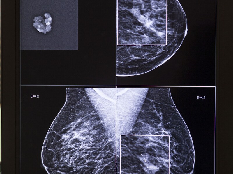 Een mammogram