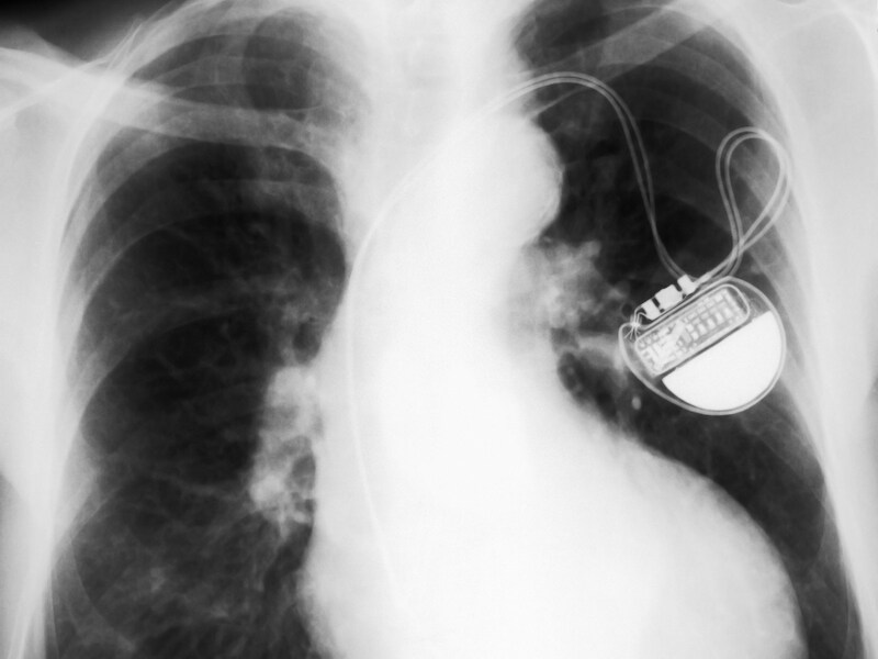 Een traditionele pacemaker.