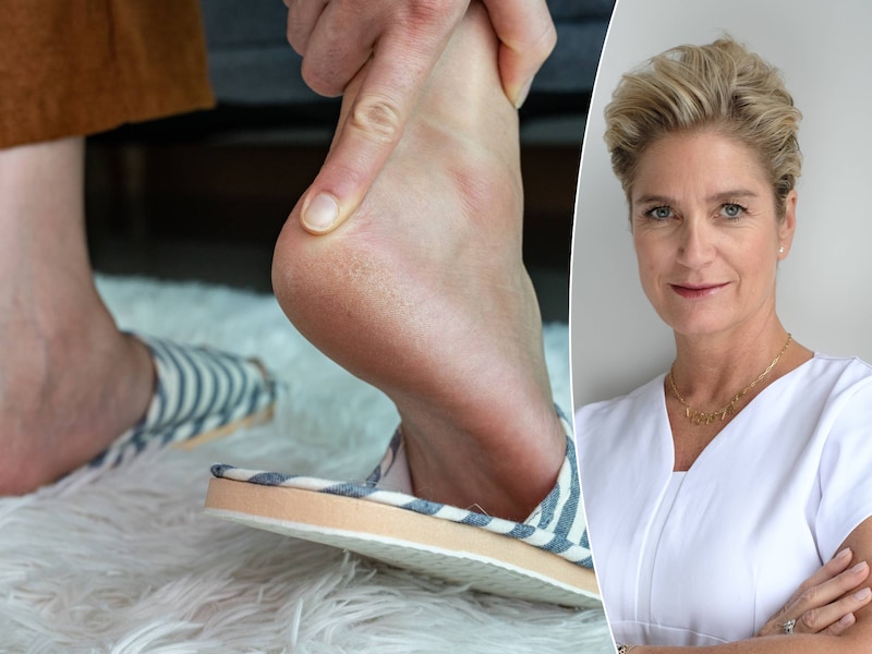 Last van eelt of droge voeten? Experts delen ideale verzorgingsroutine voor de zomer: “Af en toe insmeren met bodylotion werkt niet”