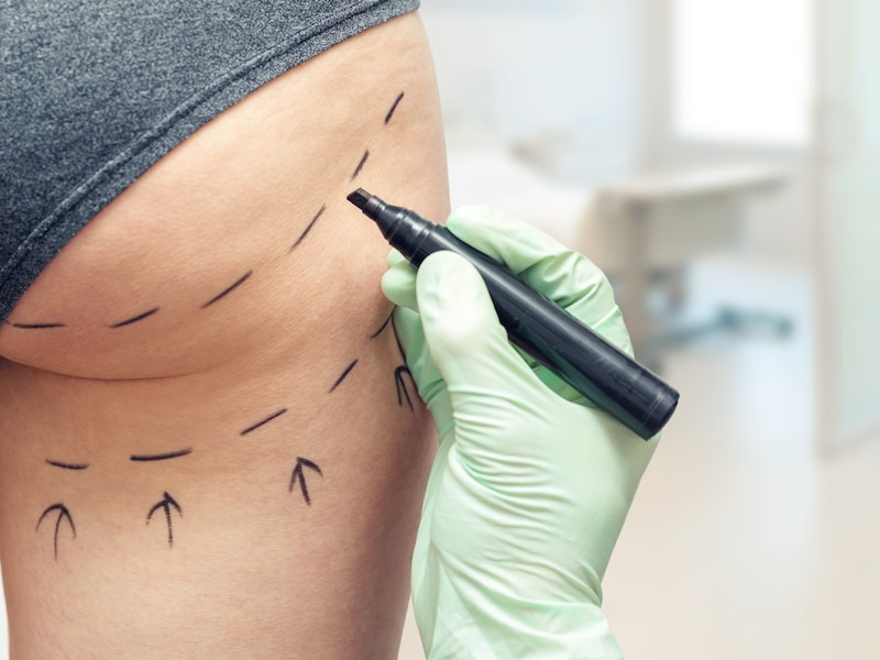 Lugubere cosmetische ingreep met ‘zombie filler’ in de VS zorgt voor gemengde reacties