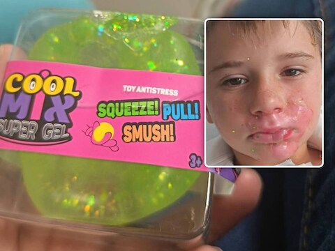Melvyn (8) loopt zware brandwonden op na explosie van populaire squishy.