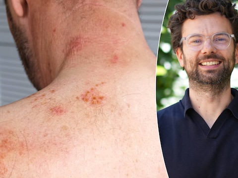 ‘Rain rot’ of regenschurft is een bacteriële huidinfectie die steeds meer mannen in Europa treft. Thibaut Vanbaelen van het Instituut voor Tropische Geneeskunde licht toe.