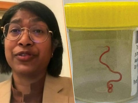 Neurochirurge Hari Priya Bandi deed de akelige ontdekking en haalde een levende worm uit het brein van een Australische patiënte.