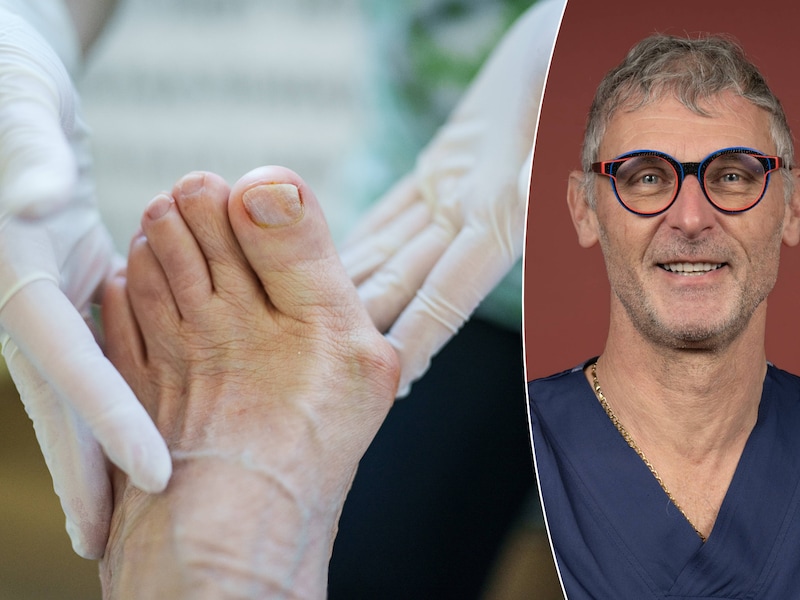 Orthopedisch chirurg prof. dr. Johan Vanlauwe over de hallux valgus.