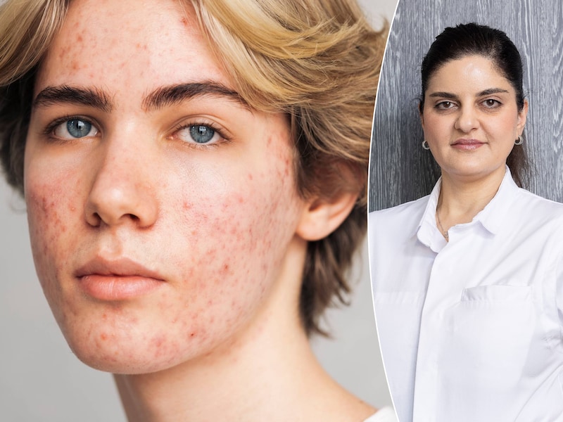 Kostprijs per sessie kan oplopen tot 500 euro: waarom zijn laserbehandelingen tegen acne zo geliefd? “Grote impact op levenskwaliteit”