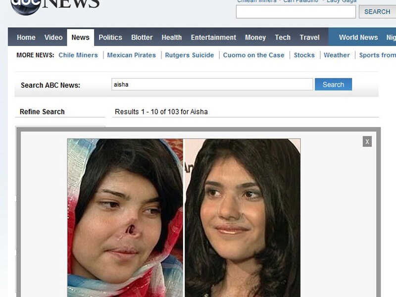 Bibi Aisha voor en na haar operatie in Los Angeles
