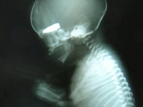 De kogel in het hoofd van de foetus is duidelijk zichtbaar.