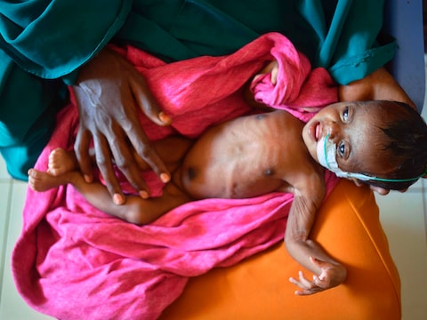 Een zwaar ondervoed kind op de schoot van haar moeder in een UNICEF-ziekenhuis in Somalië.