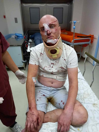 Dmitry (31) uit Zonhoven zwaar toegetakeld bij brute overval in Moldavië: “Hij lag in een plas bloed en had een schedelbreuk”
