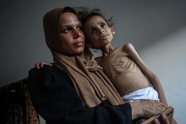 De 9-jarige Maryam Abdulaziz Mahmoud Davvas die vanwege de Israëlische aanvallen met haar familie naar Gaza-Stad gevlucht is, weegt door de hongersnood nog maar net tien kilo en kan niet meer lopen. Voorheen woog ze 25 kilo. Onderzoek in het ziekenhuis heeft uitgewezen dat haar ondergewicht enkel te wijten is aan ondervoeding en geen andere onderliggende oorzaak heeft. De foto is op 31 juli 2025 genomen.