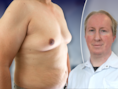 Steeds meer mannen hebben ‘manboobs’. Zo geraak je ervan af: “Gewoon vermageren volstaat vaak niet”