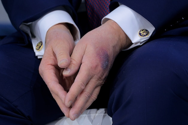 Trump has visible bruises on his hands.