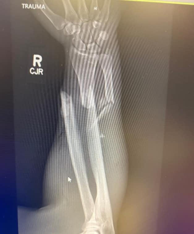 The bear bit Crago on his right forearm, breaking both bones.