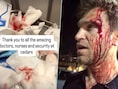 Keegan Allen uit ‘Pretty Little Liars’ geeft update na brutale overval: acteur deelt foto van hechtingen in gezicht