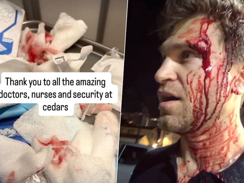 Keegan Allen uit ‘Pretty Little Liars’ geeft update na brutale overval: acteur deelt foto van hechtingen in gezicht