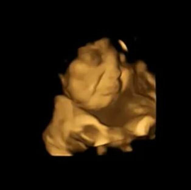 De gelaatsuitdrukking van de foetus nadat de moeder boerenkool had gegeten.