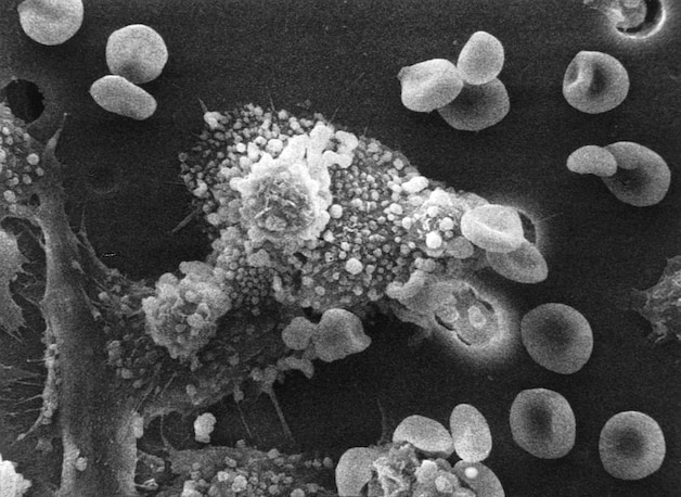 Een tumor wordt aangevallen door afweercellen.