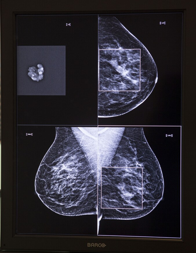 Een mammogram