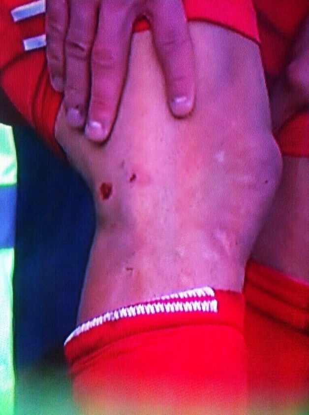 Het resultaat van Mirallas' aanslag op Suarez.