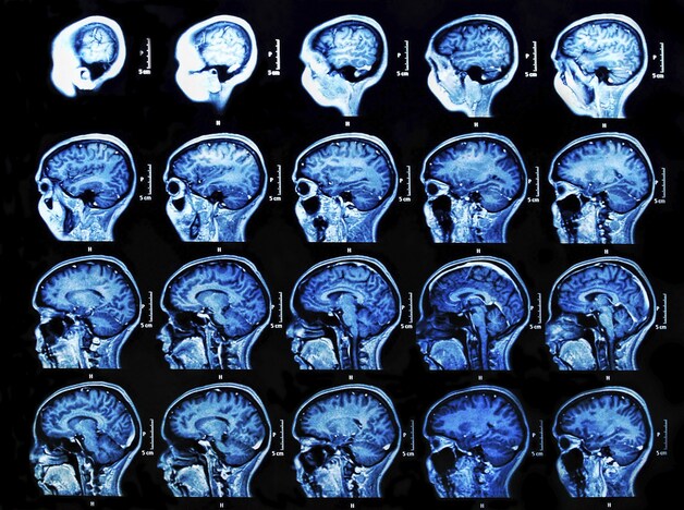 MRI hersenscan