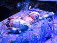 Vroeggeboorte leidt tot redelijk wat gezondheidsproblemen.