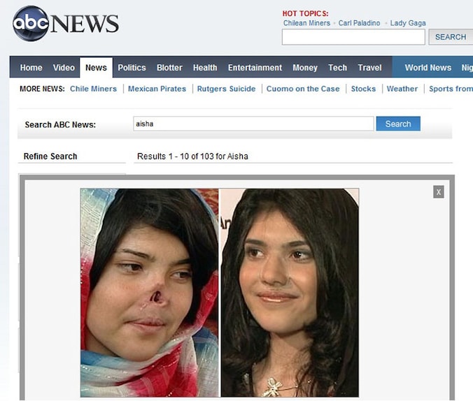 Bibi Aisha voor en na haar operatie in Los Angeles