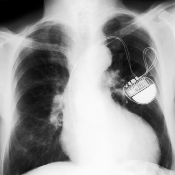 Een traditionele pacemaker.