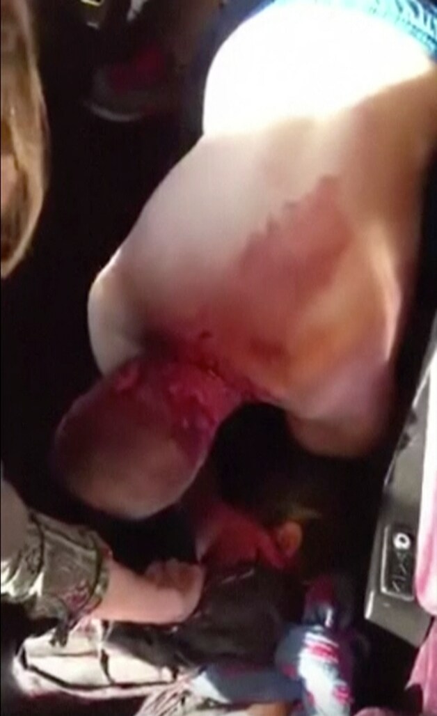 Spencer liep tijdens de schermutseling verwondingen op aan hand en nek.