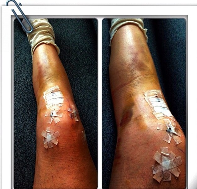 Vonn toonde haar gehavende knie na de operatie.
