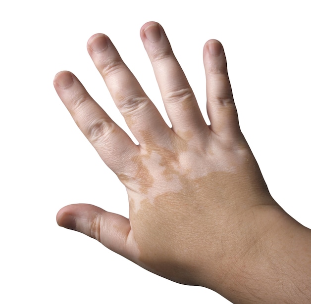 Het resultaat van vitiligo.