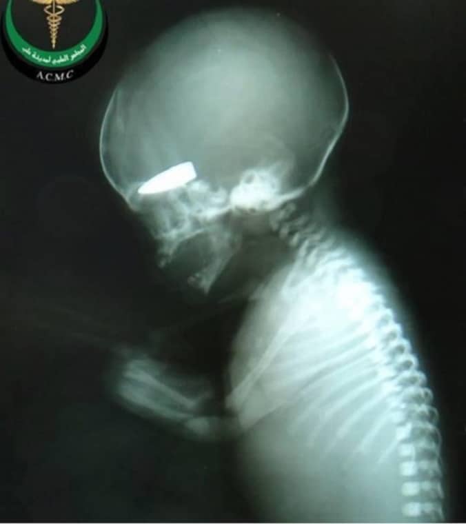 De kogel in het hoofd van de foetus is duidelijk zichtbaar.