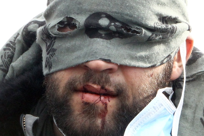 Een Iraanse vluchteling die uit zijn barak werd gezet en uit protest zijn mond dichtnaaide ten teken van hongerstaking.