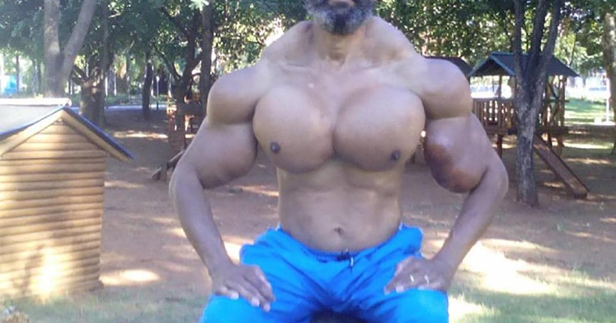 En toen ging het fout: bodybuilder spuit olie in zijn spieren en nu ziet hij er zo uit