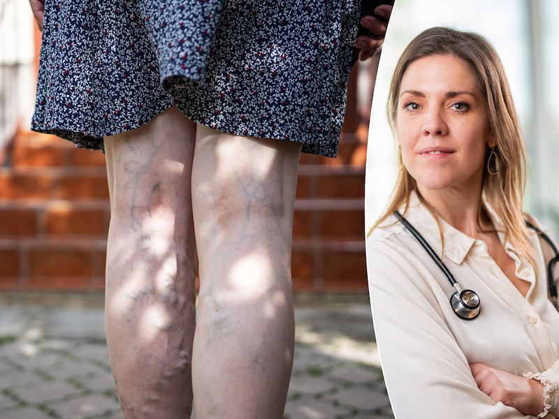Zichtbare aders op benen kunnen op een aandoening wijzen: huisarts legt uit wanneer je naar de dokter moet
