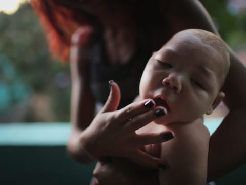 Een vijf maanden oude baby met microcefalie in Recife. De aangeboren afwijking wordt in verband gebracht met het zikavirus.